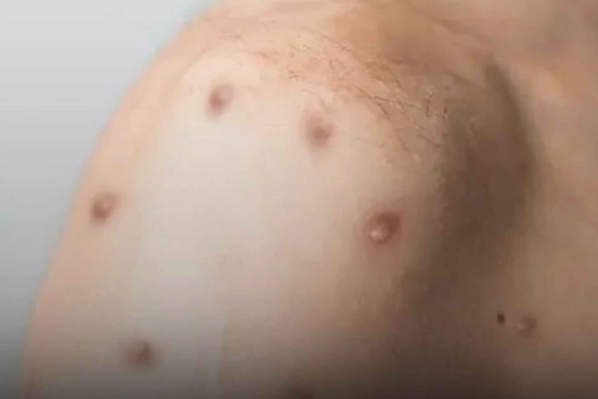 Dois casos suspeitos de Mpox são investigados em Anápolis; Goiás já soma 15 notificações em 2026