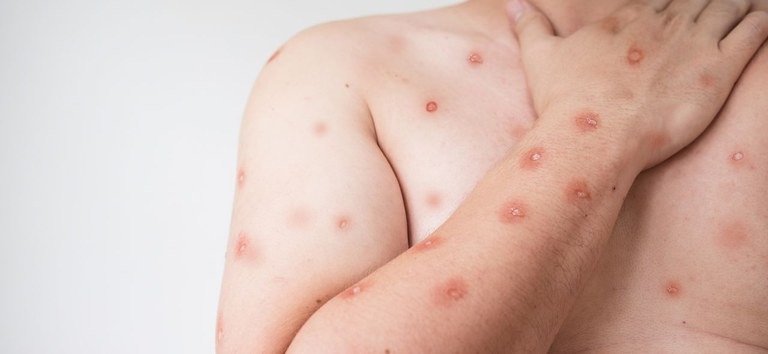 Goiás mantém cinco casos de Mpox sob investigação; Saúde orienta população sobre prevenção e atendimento
